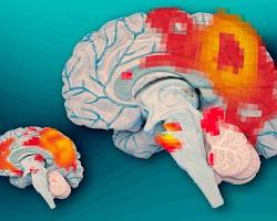 graphic illustrating the brain of a person with ADHD, highlighting the affected areas resmi
