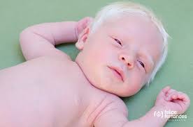 Image result for albino people
