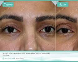 Image of نتائج شد الجفون بلكسر بلازما قبل وبعد Plexr Plasma eyelid lift before and after