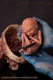 Image result for teratoma