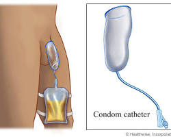 Image of Texas catheter