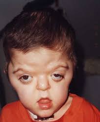 Resultado de imagen para sindrome