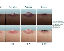 Image of Monkeypox rash stages