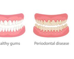 Image of Receding Gums