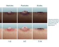 صورة Monkeypox rash progression