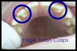 Résultat de recherche d'images pour "shovel shaped incisors"