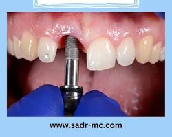 ایمپلنت دندان در سپاهان شهر