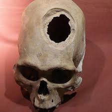 Many believe that brain surgery is a relatively modern phenomenon...But the archaeological record shows that humans have been cracking open one another's heads for thousands of years through the practice of trepanation!