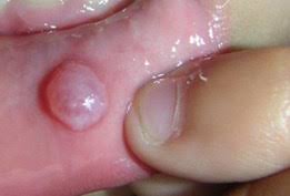 Znalezione obrazy dla zapytania Cysta