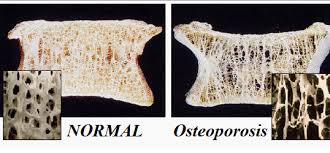 Resultado de imagen para osteoporosis