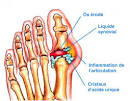 Goutte : causes, symptmes traitements Creapharma