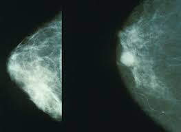 Scientists uncover breakthrough in battle against breast cancer - 5