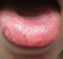 Burning Mouth Syndrome