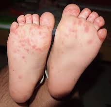 How does the hand, foot and mouth disease (HFMD) spread? The virus spreads very easily through coughing and sneezing and also through infected stool. - hfmd