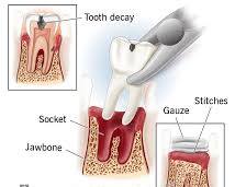 Image of Tooth Extraction