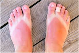 Image result for toddler sunburn