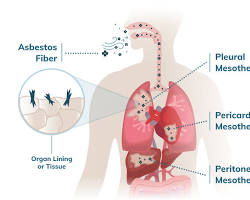 Image of Mesothelioma cancer