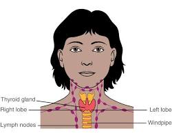 Image of Thyroid gland on the neck