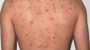 Viruela del Mono: detectan el primer caso de una variante más contagiosa y severa en Argentina