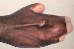 Résultat de recherche d'images pour "shovel shaped incisors"