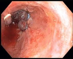 Imagini pentru esophageal varices rupture