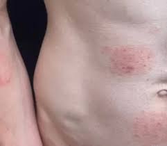 Verme ‘altamente contagioso’ transmitido por via sexual gera alerta em diversos países