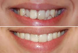 Image result for invisalign images before after