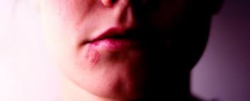 The Surprising Link Between Cold Sores and Alzheimer's Disease