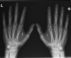 Image result for introduccion del microchip para personas en estados unidos