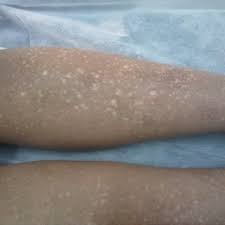 a. Skin lesions of patient revealed hyperpigmentation with ...