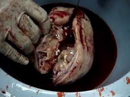 Image result for teratoma