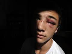 Chad Cupido. A 14-year-old rugby player was left with a broken nose, cut eye, mild concussion, bruises and swelling after his face ... - 572290130