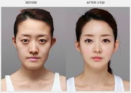 Resultado de imagem para before after surgery