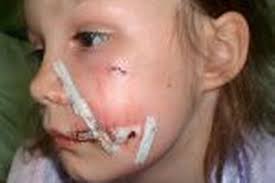 COURTNEY Walker, nine, suffered horrific facial injuries when she was attacked at a neighbour&#39;s house by the family&#39;s bull mastiff. - C_71_article_522358_body_articleblock_0_bodyimage