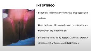 Image result for newborn diaper rash
