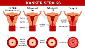 Image result for kanker