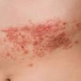 Shingles Recurs More Often Than Thought