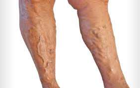 Image result for dvt