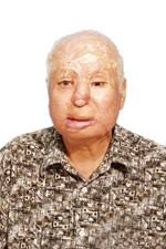 Nhà báo Trần Quang Thành chụp năm 2006, năm 65 tuổi, sau 15 năm bị tạt axit, mù mắt trái, thương tật 81%. Sau 15 lần phẫu thuật để tạo hình mặt mũi. - TranQuangThanh150b