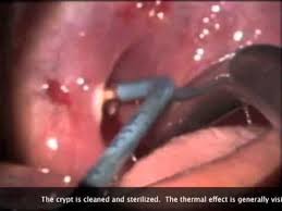 Image result for tonsilith