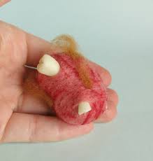 Image result for teratoma