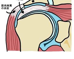 肩関節周囲炎の画像