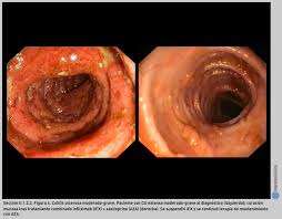 Resultado de imagen para colitis ulcerosa