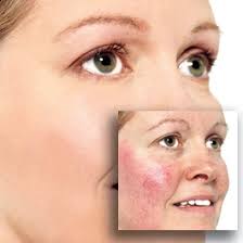 tratamiento para la rosacea en la cara