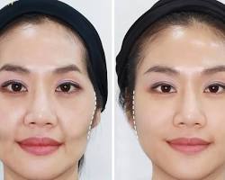 Hình ảnh về khuôn mặt trước và sau khi tiêm má baby