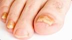 Les traitements pour une mycose des pieds ou des ongles - Top Sant