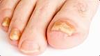 Les traitements pour une mycose des pieds ou des ongles - Top Sant