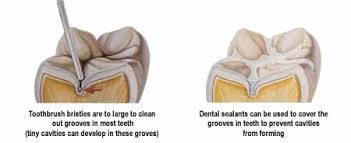 Image result for fissure sealant