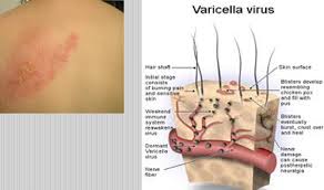 Image result for "Herpes Zoster"