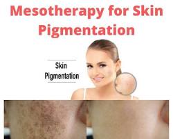 Image of Mesotherapy for pigmentation